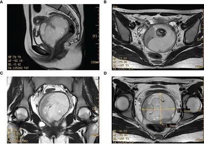 Patient-derived organoids facilitating individual therapy in an adolescent with embryonal rhabdomyosarcoma of the cervix: a case report and literature review